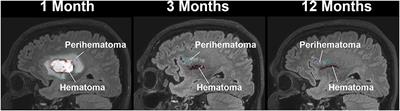 Longitudinal, Quantitative, Multimodal MRI Evaluation of Patients With Intracerebral Hemorrhage Over the First Year